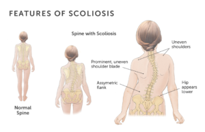 pilates-for-scoliosis